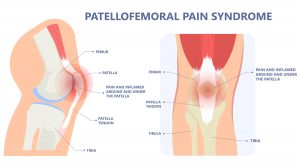 Patellofemoral Pain Syndrome