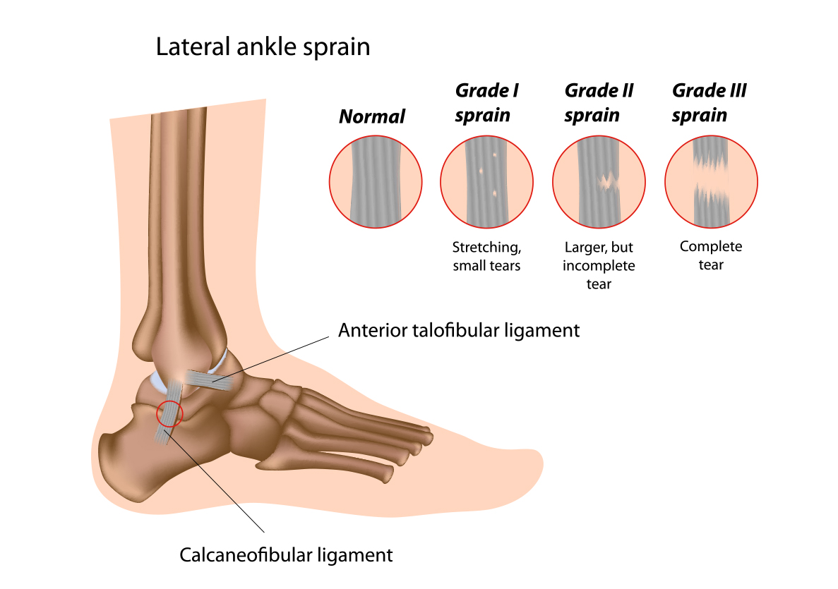 Lateral Ankle Sprain: Ankle Sprain Treatment | Hartwell Physiotherapy