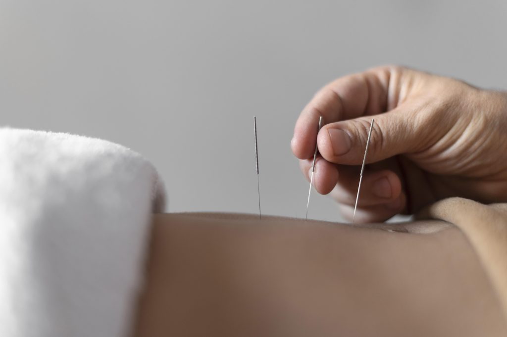 Dry Needling Therapy Melbourne