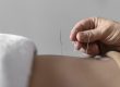 Dry Needling Therapy Melbourne