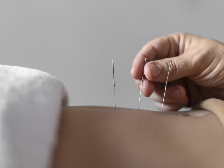 Dry Needling Therapy Melbourne